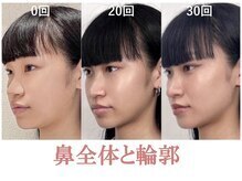 ラプリ 札幌ル・トロワ店/隆鼻＋輪郭矯正40分　30回