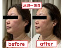 ウェルクス(welux)/美容×グローパック★