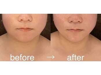 プール エドボリ(POOL EDOBORI)/小顔コルギ＋カッサ＋マシン80分