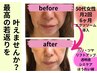炭酸パックフェイスエステ＋高濃度人幹細胞上清液＋国産エクソソーム導入