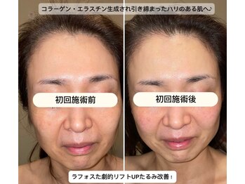 久遠(kuon)/切らない小顔リフト♪