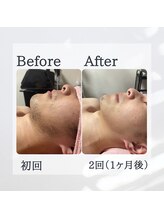 ティグレ 岡山店(TIGRE)/メンズ顔脱毛