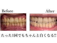 ノーブル 上土店(Noble)の雰囲気（世界初のホワイトニングジェルで1回でもしっかり白さを実感！！）