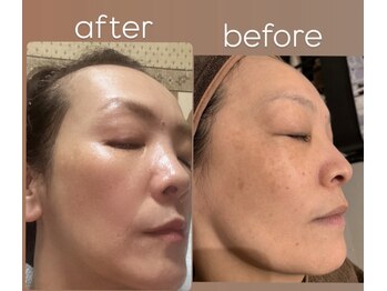 ヒーリングサロン イチマルイチ(101)/白玉スノーピーリング