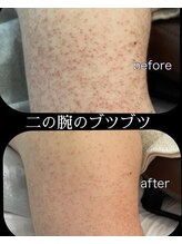 スリリアン 銀座/★ニキビ劇的ビフォーアフター★