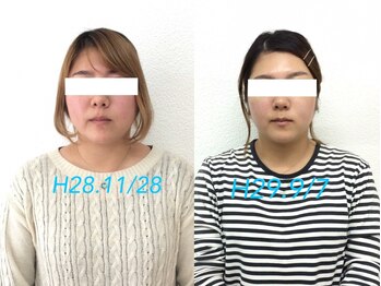 ビューティスタジオＫ/小顔矯正ビフォーアフター