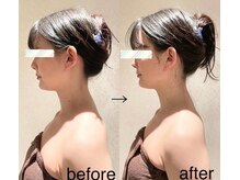 ビュール 銀座(BeauL)/小顔ケア