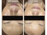 【男女OK】全ての肌悩みに最強の組み合わせ！肌質改善コース☆通常22,000円