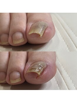 リリ(lili)/巻き爪矯正/1回目