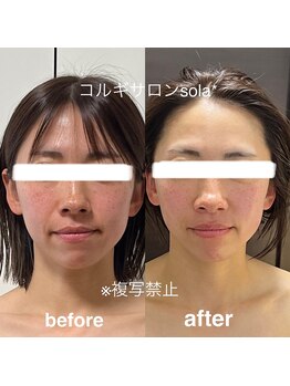 ソラ(sola*)/歪みを整えほうれい線撃退!