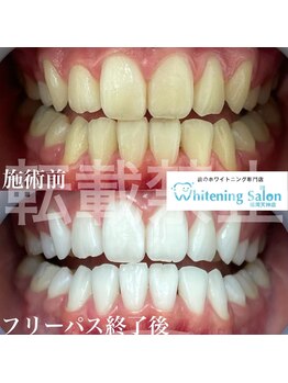 ホワイトニングサロン 福岡天神店/ホワイトニング