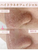 ココロ(COCORO)/毛穴洗浄　ビフォーアフター
