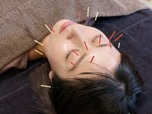 たかはし治療院/美容鍼でフェイスラインスッキリ