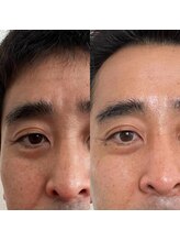 ウイユ(Oeil)/剥けるハーブピーリング施術直後