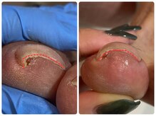 爪のいろは/巻き爪補正