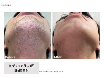 プリズム/男性ヒゲ脱毛のビフォーアフター