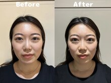 くにたちNyan鍼灸整体院/【小顔矯正】Before After 13