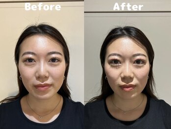 くにたちNyan鍼灸整体院/【小顔矯正】Before After 13