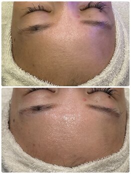 アメリオレ(ameliorer)/αIPLUS 光フェイシャル