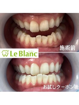 ルブラン 奈良店(Le Blanc)/頑固な着色汚れも白く！