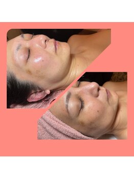 サロン ド オージャス(salon de ojas)/光フェイシャル