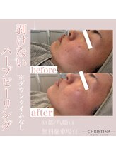 エイム(eim)/ハーブピーリング