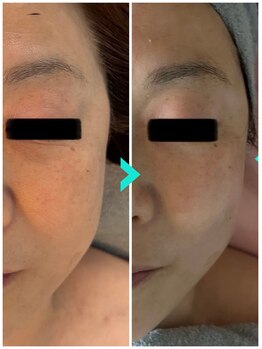 ミルキー(Milky)/小顔コルギでリフトアップ