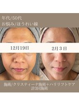 マール(MARL.)/たるみ・ざらつき/お悩み改善♪