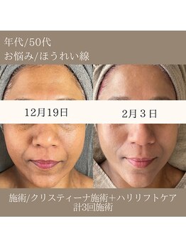 マール(MARL.)/たるみ・ざらつき/お悩み改善♪