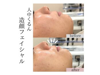 フロリール アザブジュウバン(FlorirAzabujuban)/小顔/リフト/たるみケア