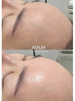 アザレア(Azalea)/3Dキュアピール/恵比寿