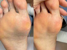 キラネイル アンド アイラッシュ by World Beauty(KIRA)/フット角質除去