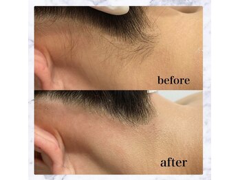 シュバル(CHEVAL)/うなじ美人！うなじワックス脱毛