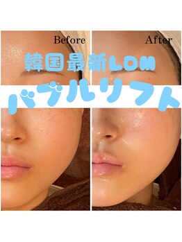 バブルビューティー(Bubble beauty)/LDM水玉リフティング