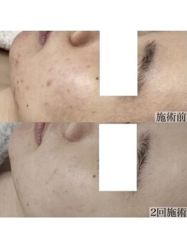 ヴェルシック(Belchic)/月1の剥けないハーブで理想へ