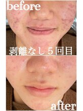 エミルカ 千葉店(EMILUCA)/ハーブピーリング/顔赤いニキビ