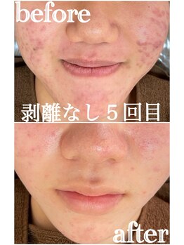 エミルカ 千葉店(EMILUCA)/ハーブピーリング/顔赤いニキビ