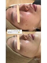 サロンモア(salon More)/ハーブピーリング＋LED