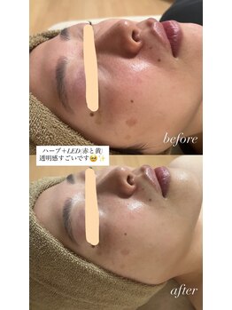 サロンモア(salon More)/ハーブピーリング+LED