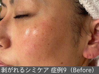 オアシスラグーン(OASIS LAGOON)/シミケア(症例9 before)40代