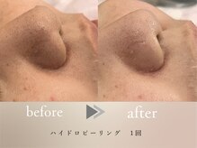 グロッシー(glossy)/【症例】小鼻皮脂詰まり黒ずみ