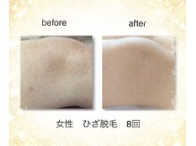 KMB 恵比寿店/NPL脱毛、女性ひざ、8回