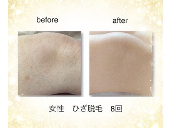 KMB 恵比寿店/NPL脱毛、女性ひざ、8回