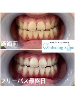 ホワイトニングサロン 熊本店/簡単セルフホワイトニング