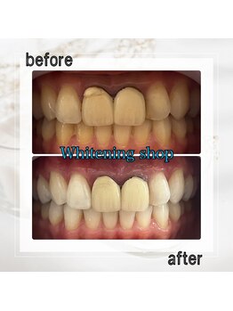 ホワイトニングショップ 亀戸店/【亀戸】美白ホワイトニング