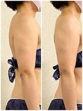 リンド(Lindo)/筋膜リリース