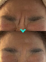 ミルキー(Milky)/マツヤニでシワも整える