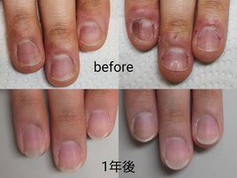 深爪矯正1年、腫れなく健康的
