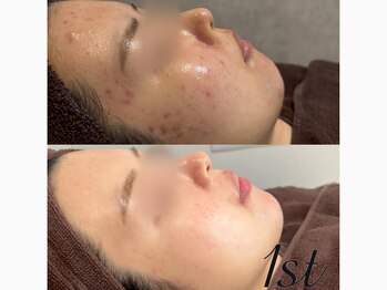 ファースト(1st)/