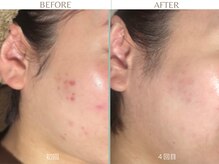 エミルカ 日の出平井店(EMILUCA)/気になるニキビ